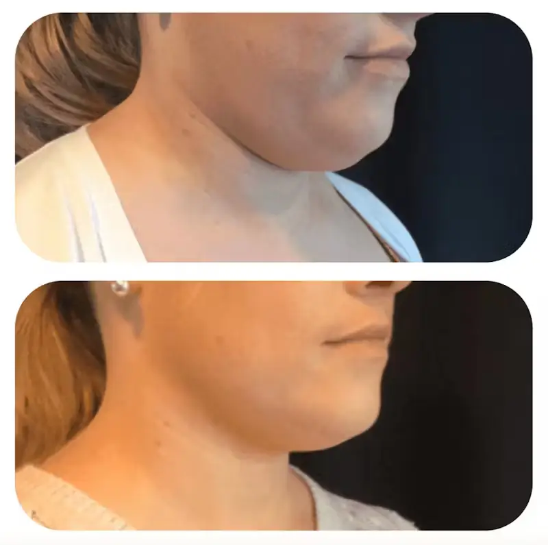 Before and after results showing reduction of double chin through cosmetic treatments