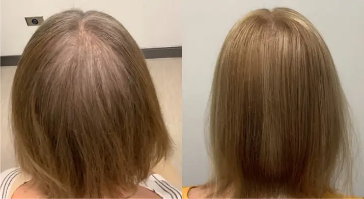 Alma TED Hair Restoration Before and After