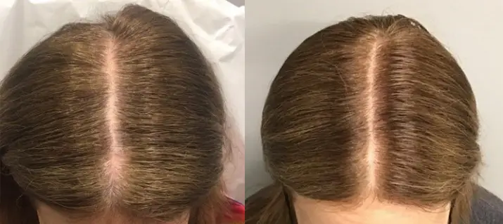 Alma TED Hair Restoration