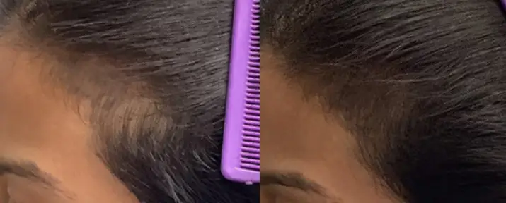 Alma TED Hair Restoration Before and After