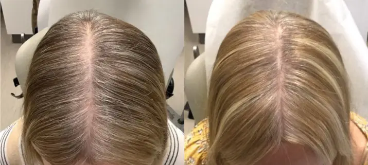 Alma TED Hair Restoration Before and After