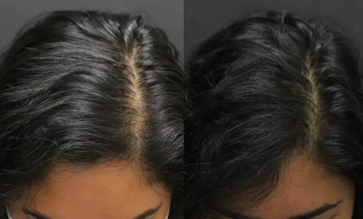Alma TED Hair Restoration Before and After