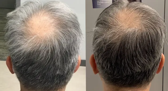 Alma TED Hair Restoration