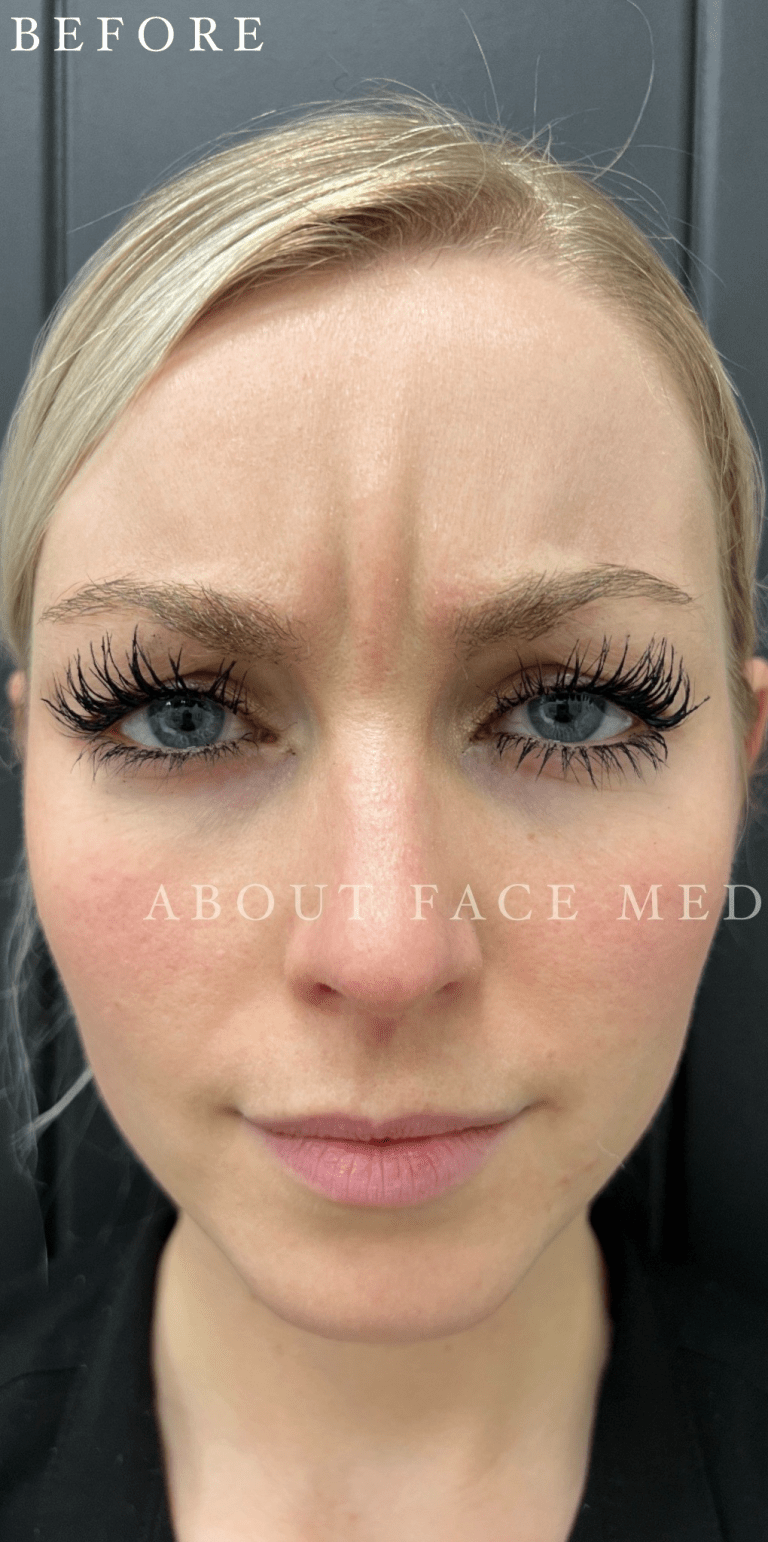 Botox before
