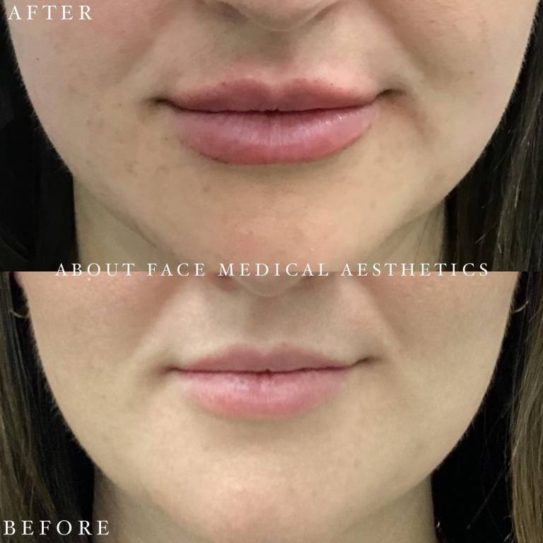 Dermal Filler Before after 3