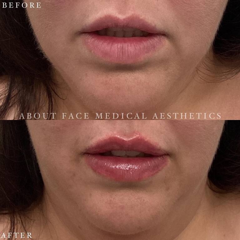 Dermal Filler Before after 4