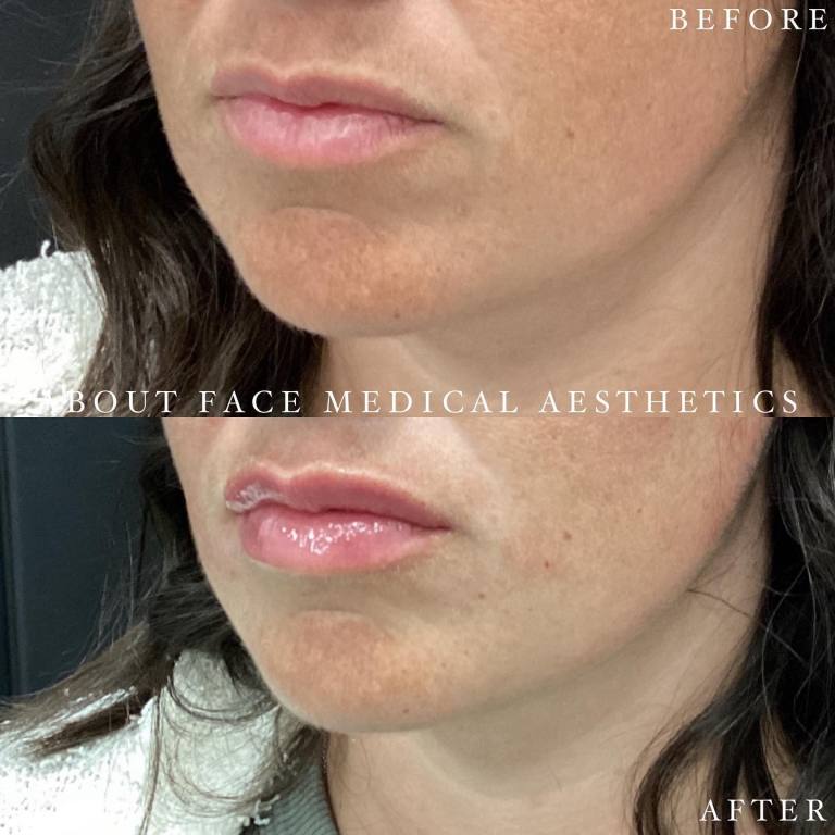 Dermal Filler Before after