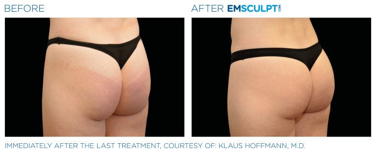 EmSculpt Neo before after