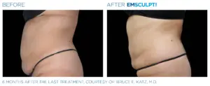 EmSculpt Neo before after
